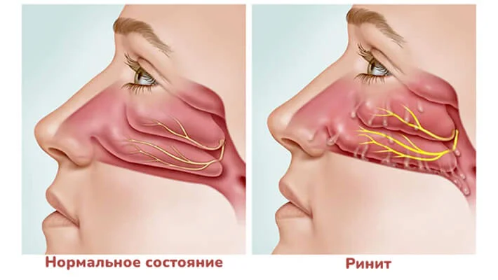 Как проявляется аллергический ринит