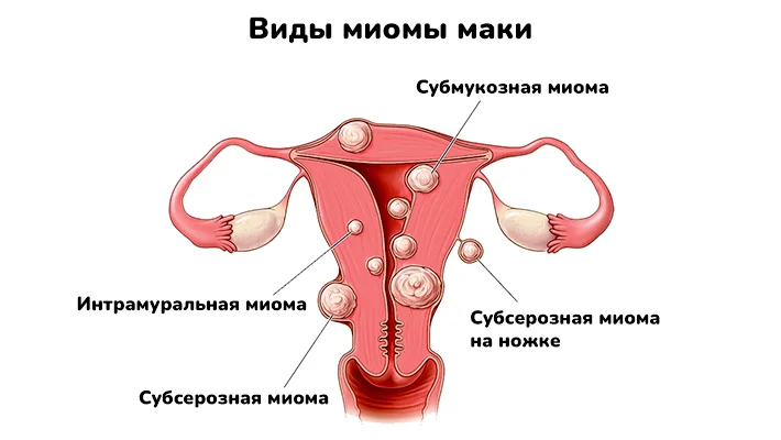 Миома матки