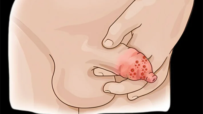 Сыпь на члене