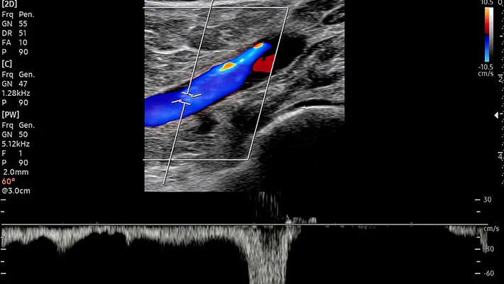 Что такое УЗДС