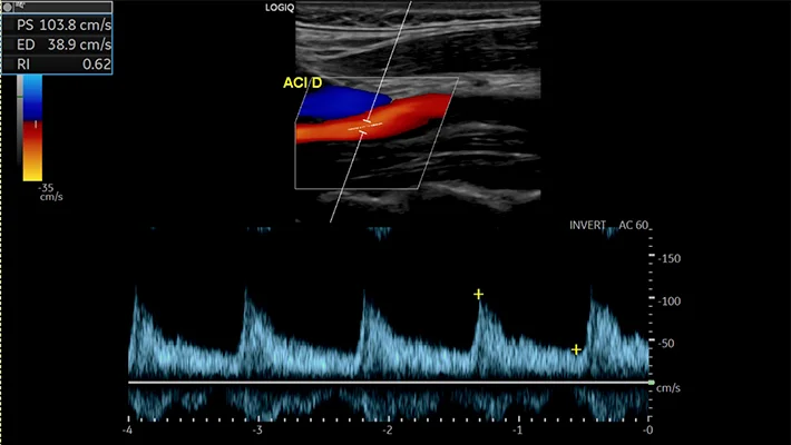 УЗИ брахиоцефальных артерий