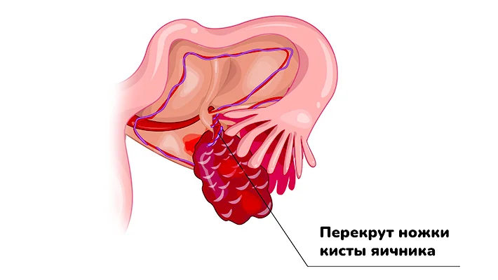  Перекрут ножки кисты яичника