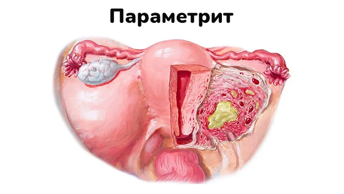 Параметрит