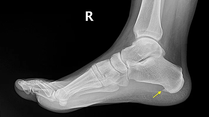 Пяточная шпора