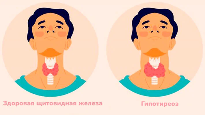 Гипотиреоз