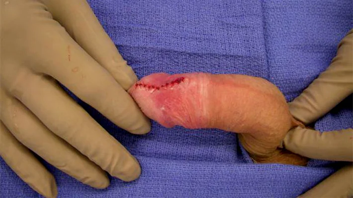 Все о френулотомии уздечки