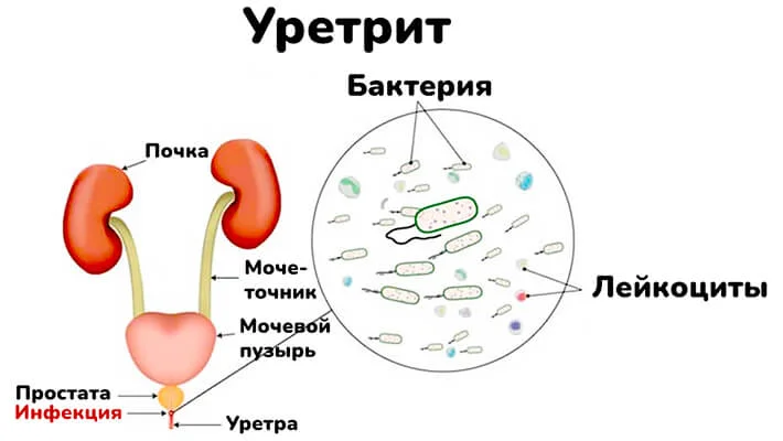 Причины уретрита