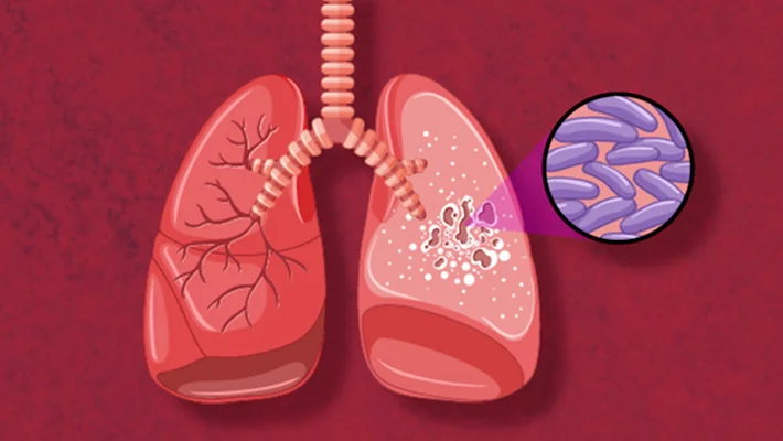 Туберкулез