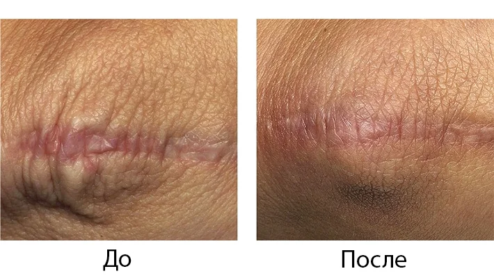 Удаление шрамов