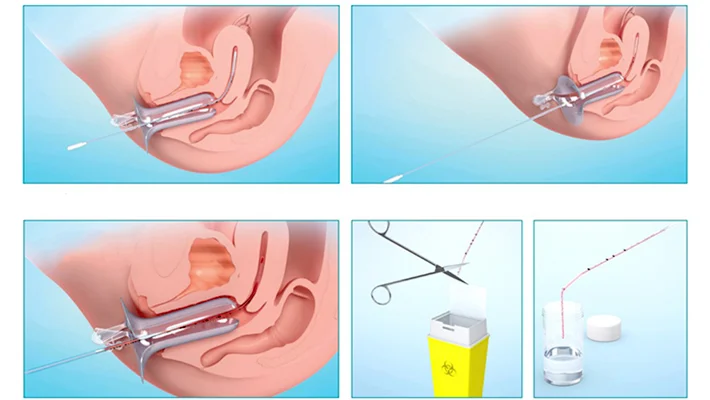 Пайпель-биопсия