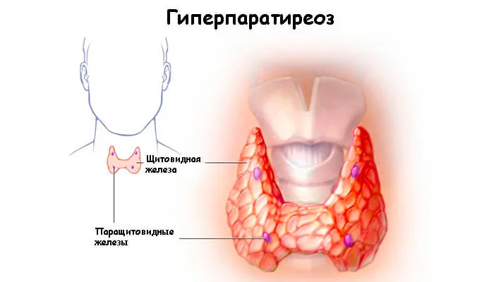 Гиперпаратиреоз