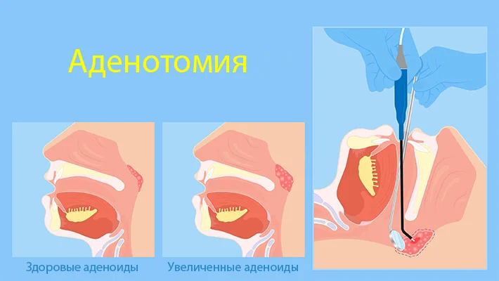 Аденотомия