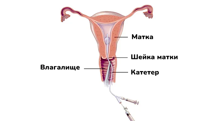 Как делают гистеросальпингографию