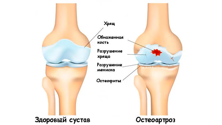 Остеоартроз