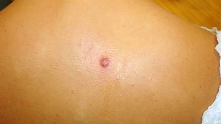 Удаление дерматофибром