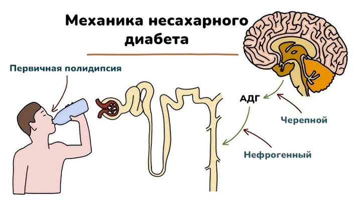 Как развивается несахарный диабет