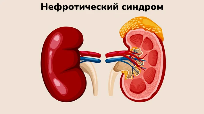 Нефротический синдром