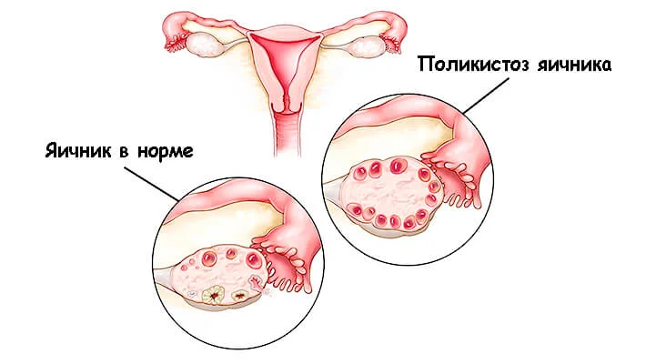 Поликистоз яичников