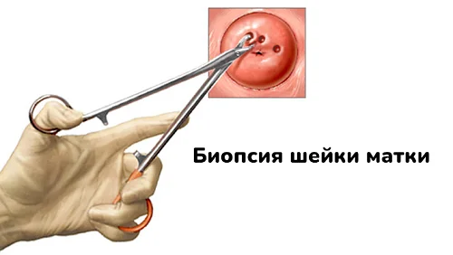Биопсия в гинекологии: как проводится, подготовка