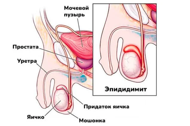 Эпидидимит