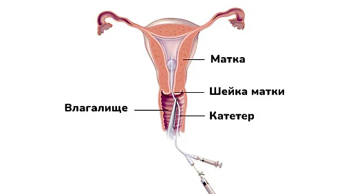 Как делают гистеросальпингографию