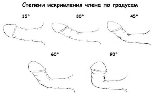 Искривление полового члена