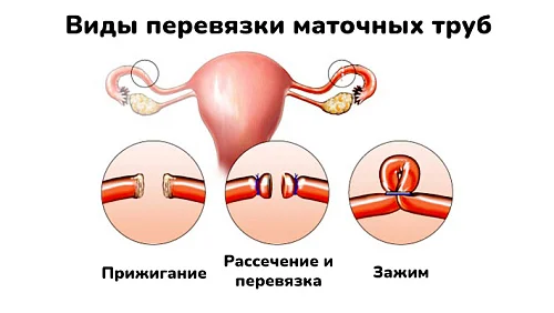Все о перевязке маточных труб