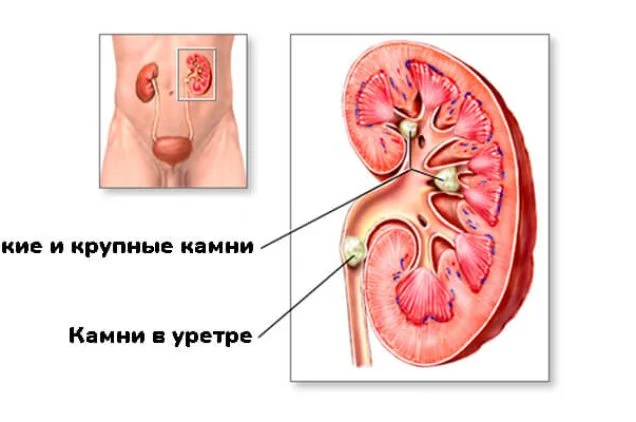 Камни в почках