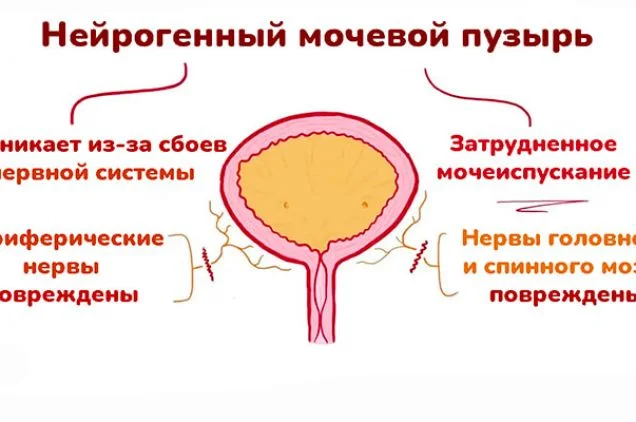 Нейрогенный мочевой пузырь