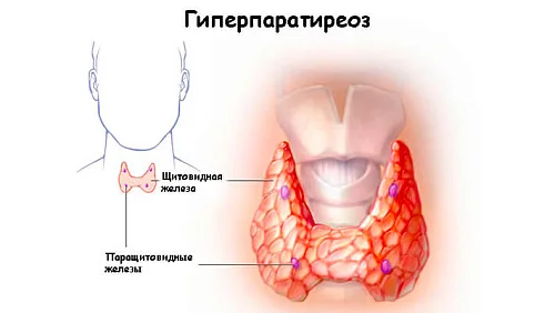 Гиперпаратиреоз