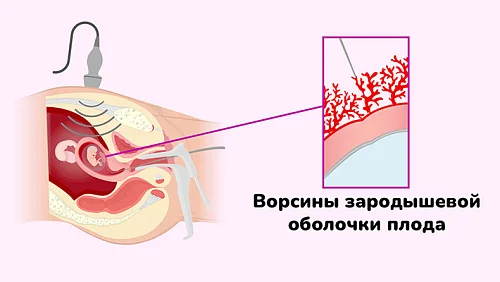 Биопсия хориона: когда проводят и что показывает исследование