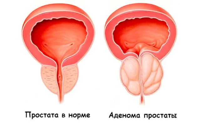 Аденома простаты