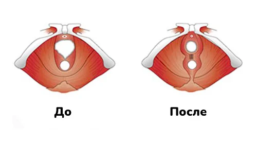 Операция по восстановлению девственности: вся информация