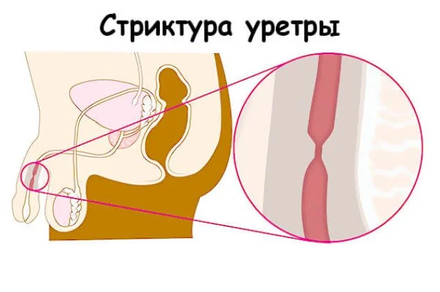 Стриктура уретры