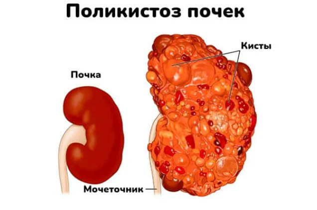 Поликистоз почек