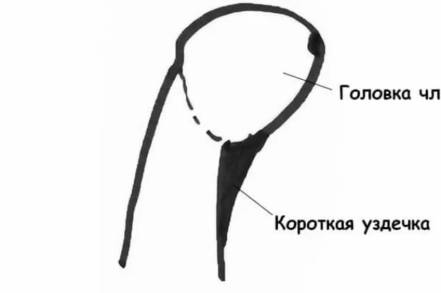 Короткая уздечка крайней плоти