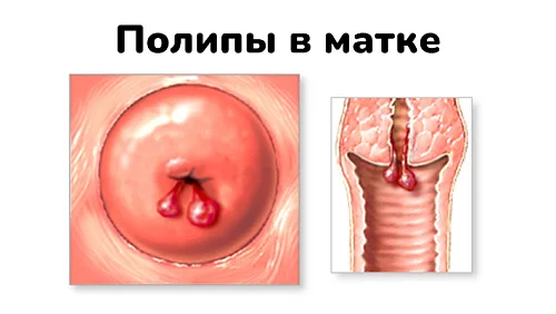 Сколько идут выделения после удаления полипа матки