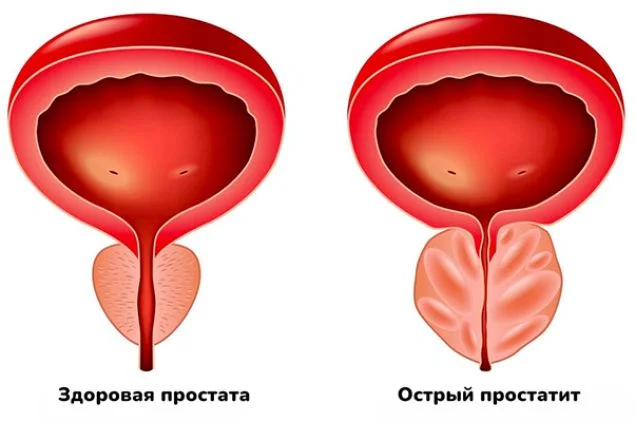 Острый простатит