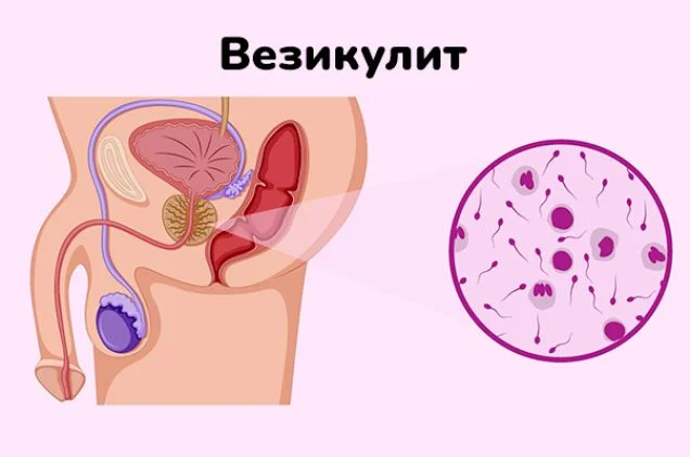 Везикулит
