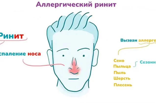 Аллергический ринит