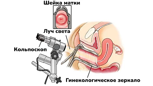 Все о кольпоскопии шейки матки
