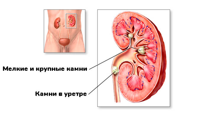 Камни в почках