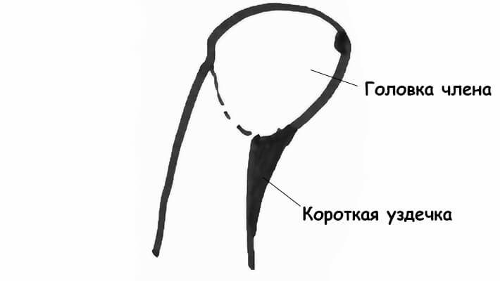 Короткая уздечка крайней плоти