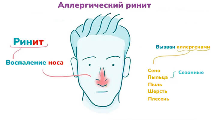 Аллергический ринит