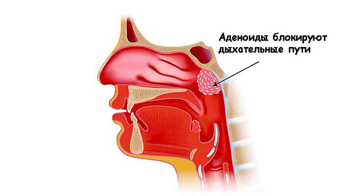 Аденоиды