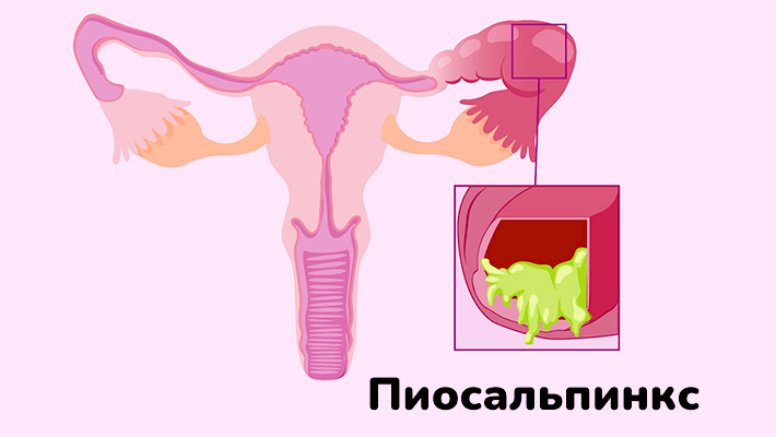 Пиосальпинкс