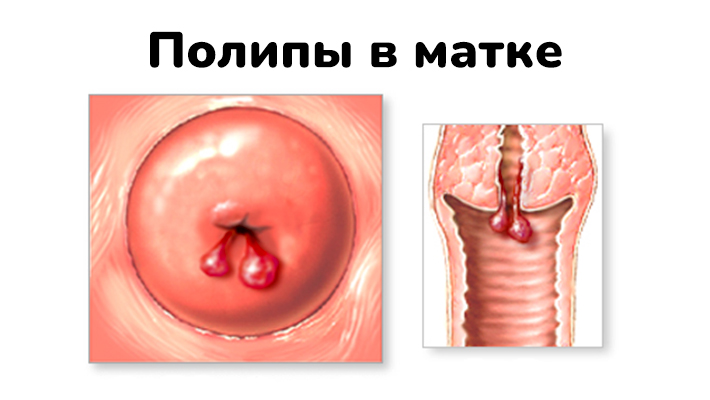 Сколько идут выделения после удаления полипа матки