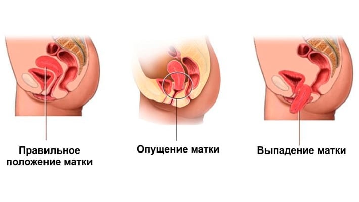 Схематичное изображение патологий матки