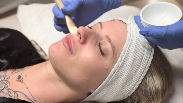 Пилинг Джесснера