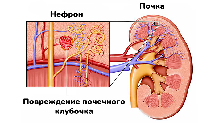 Острый гломерулонефрит